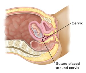 Cross section of pelvis showing baby developing in uterus with sutures holding cervix closed.