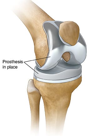 Knee joint, with total knee prosthesis in place.
