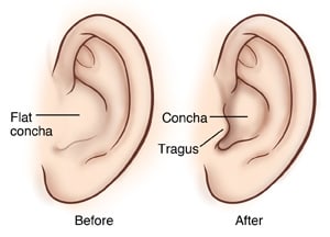 Absent tragus and flat concha before ear surgery, and new tragus and reshaped concha after surgery.