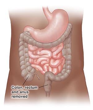 Front view of intestines with the colon, rectum, and anus highlighted showing section to be removed. 