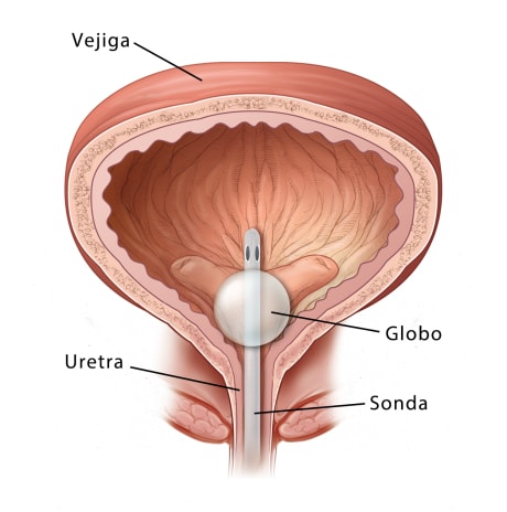 Sección transversal en vista frontal de la vejiga y la uretra, en la que se observa una sonda insertada a través de la uretra hasta la vejiga, con un globo en el extremo de la sonda que la mantiene en su sitio.