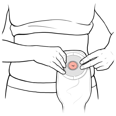 Person placing ostomy bag with stoma in center of opening.