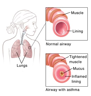 Location of lungs in child's chest, with details of normal airway and inflamed airway with more mucus due to asthma.