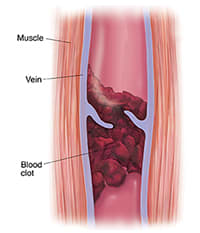Cross section of muscle and varicose vein with blood clot.