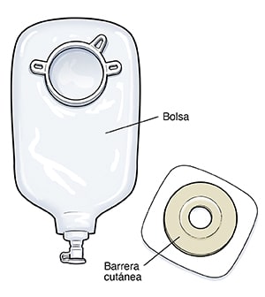 Bolsa de urostomía de dos piezas con sistema de drenaje.
