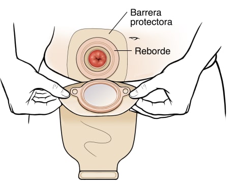 Manos colocando una bolsa de colostomía sobre el estoma.